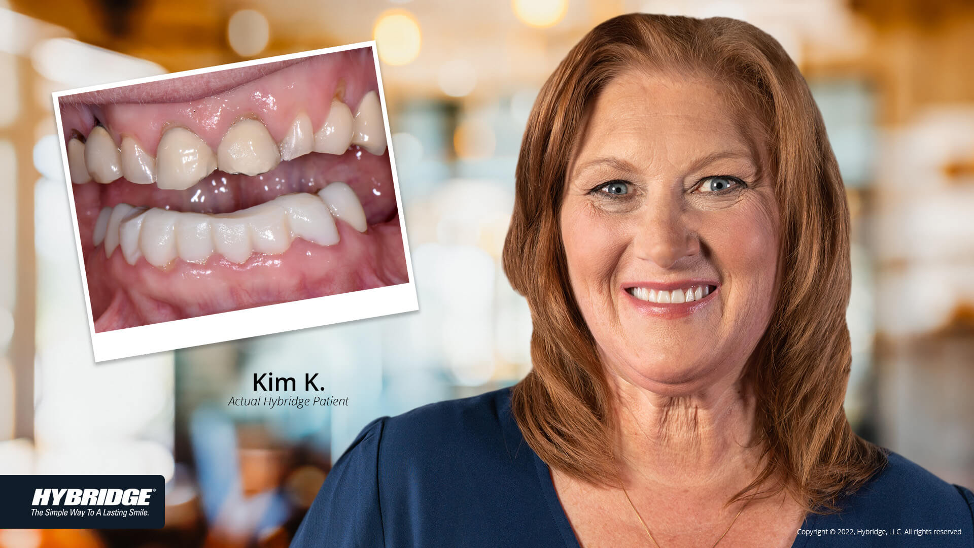 before-after_smile_gallery_w-bkgds_kim-k_1920x1080_21