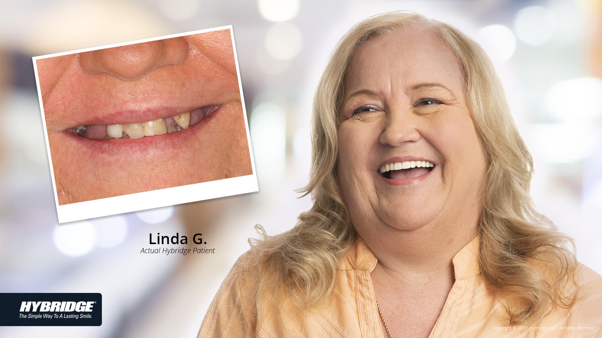 before-after_smile_gallery_w-bkgds_linda-g_1920x1080