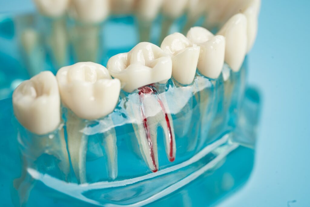 Root-Canal-Treatment-Greenbrier-TN