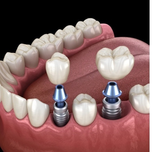 dental implant stages